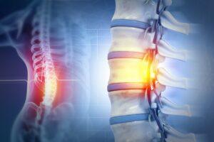 An animated photo of an injured spinal cord injury that led to a settlement worth a large amount of money